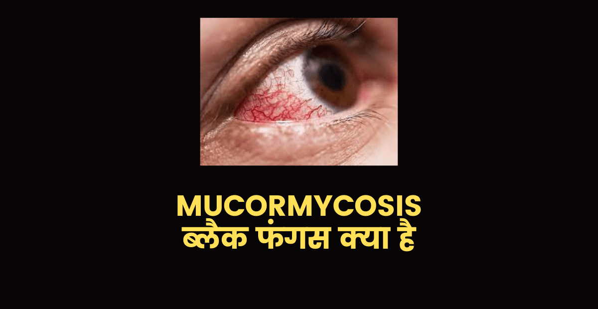 Mucormycosis